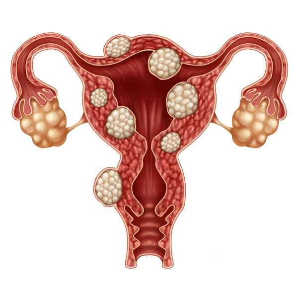 If uterine fibroids are detected before pregnancy, is contraception necessary?